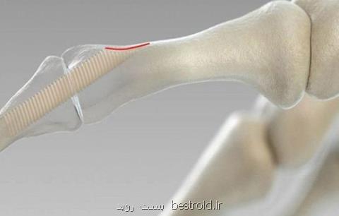 پیچ زیست تخریب‎پذیر ساخته شد، كاربرد در صدمه دیدگی های زانو